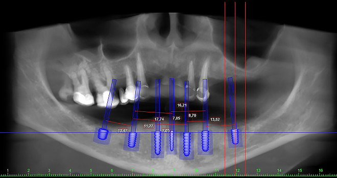 고난도 임플란트