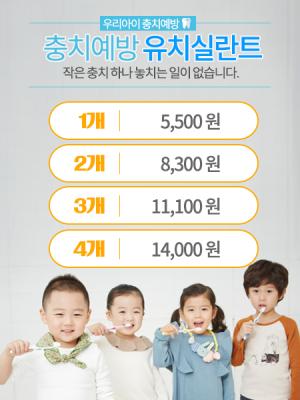 충치예방 실란트